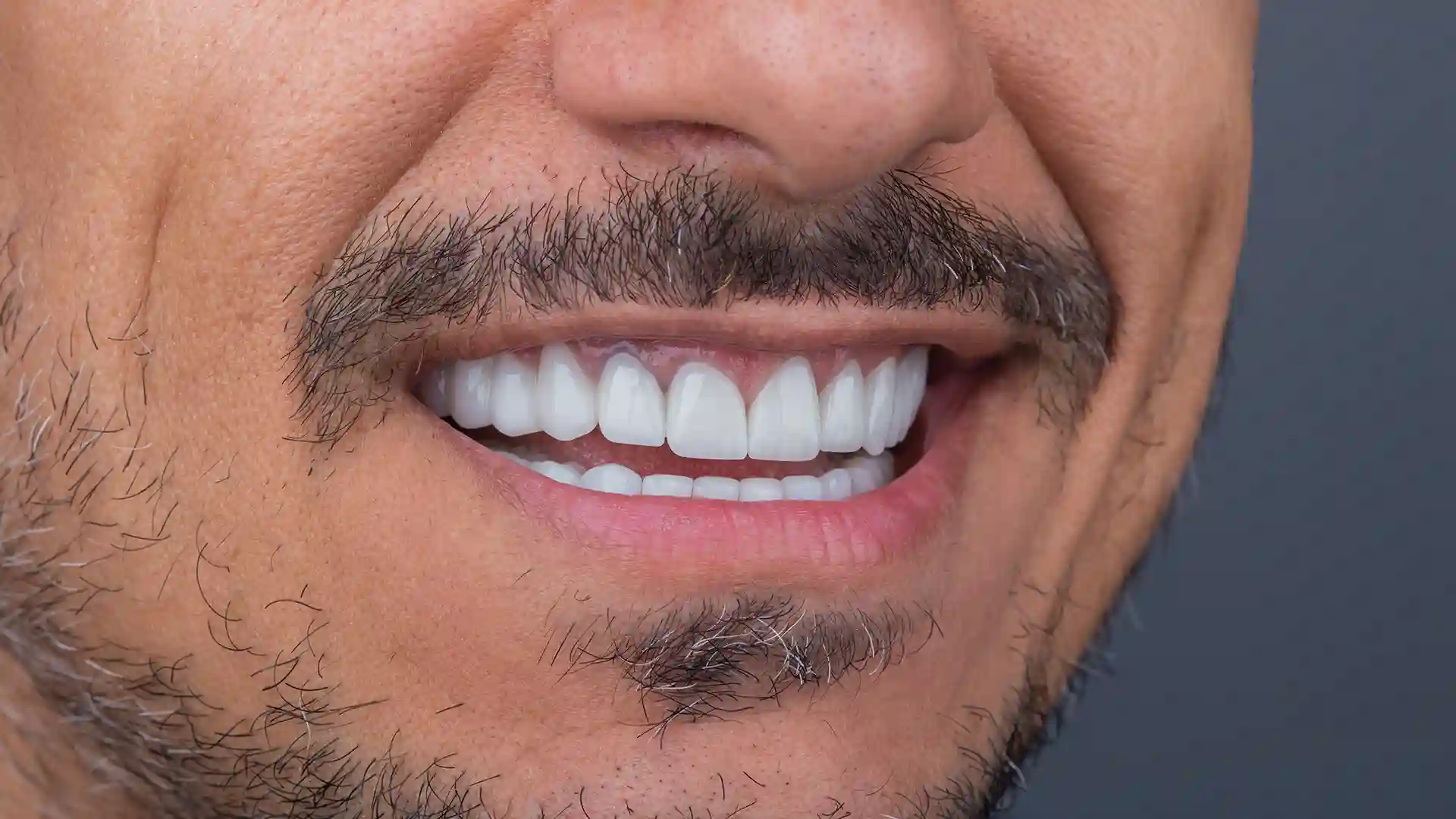 Hollywood Smile Turkey